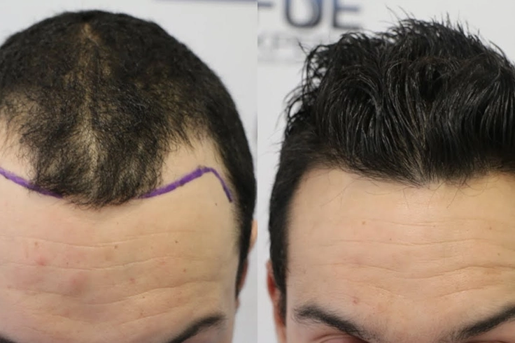 Before and after results of Bio-FUE hair transplant showing hairline regrowth and healing
