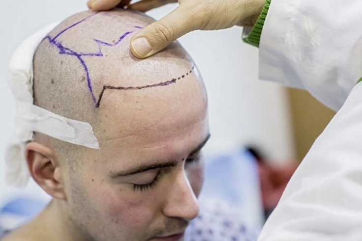Bio-FUE hairline marking before hair transplant surgery for natural hair restoration process