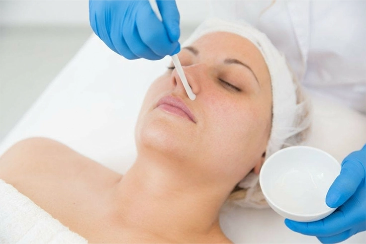 Professional Chemical Peel Treatment in Coimbatore for glowing, smooth, and rejuvenated skin.