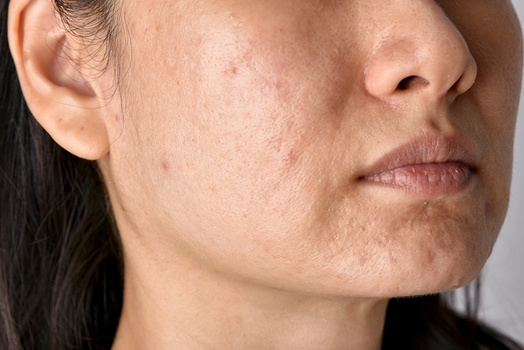 Close-Up of Skin with Acne Marks Before Treatment Woman’s cheek showing acne scars and pigmentation, suitable for before glutathione treatment visuals