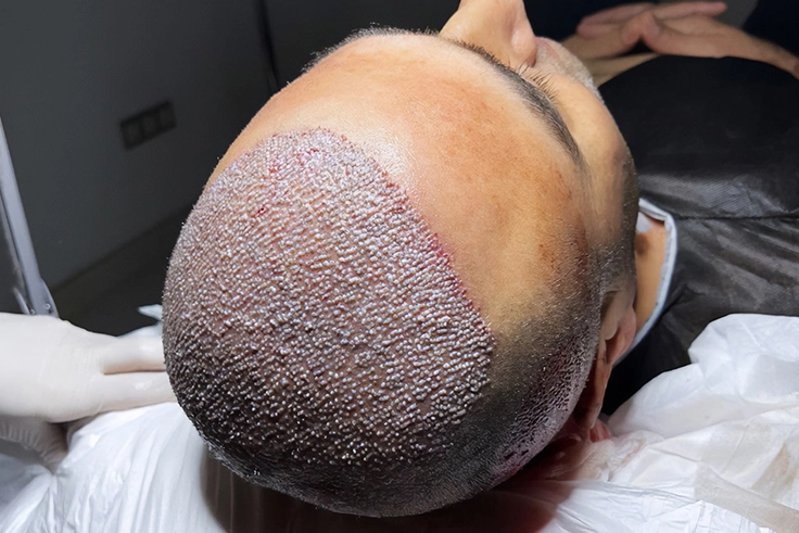 Close-up of scalp after Bio-FUE grafts placed showing hair transplant surgical procedure step