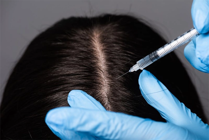  A specialist administers MESO therapy injections to the scalp, nourishing hair follicles for regrowth.