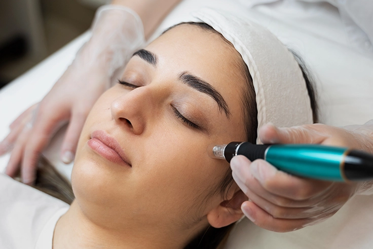 Advanced MNRF Treatment in Coimbatore for acne scars, skin tightening, and rejuvenation.