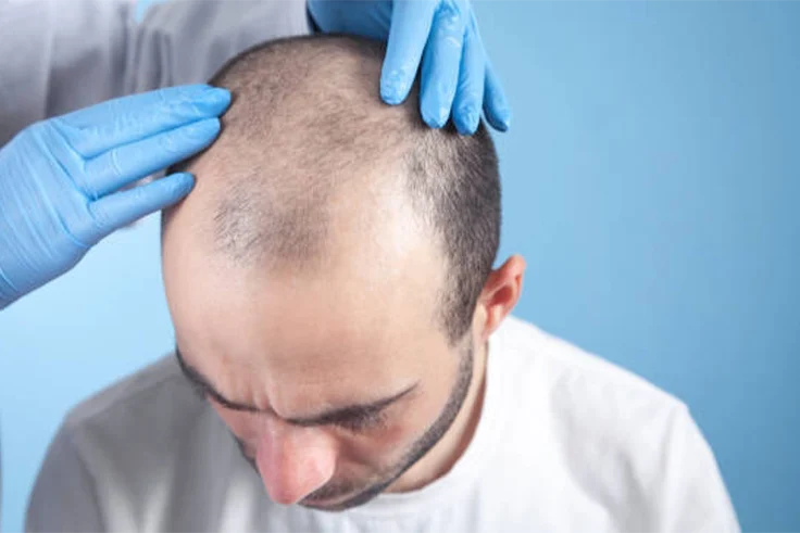 Recognize early hair loss and explore SHI hair transplant for natural-looking restoration.
