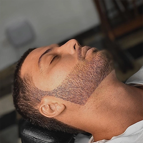 Facial hair restoration for beard and moustache coverage