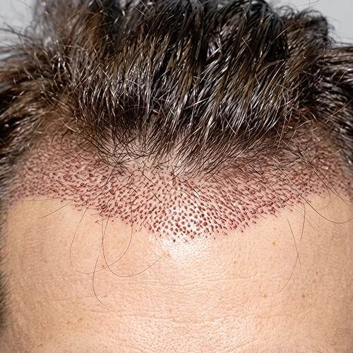 Natural frontal hairline restoration using dhi method graft placement