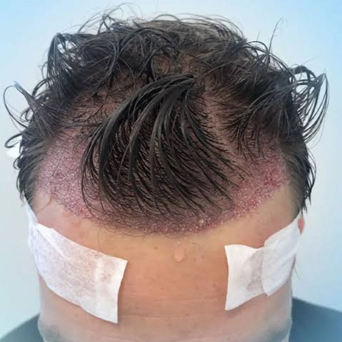 Unshaven dhi hair transplant preserving existing hair length