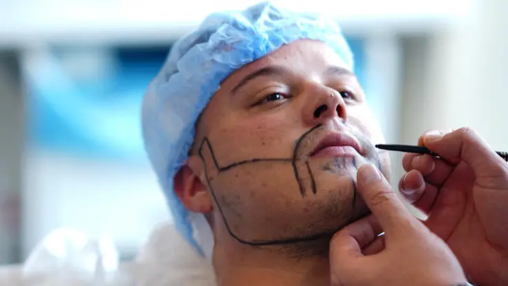 Best Mustache Hair Transplant Treatment in Coimbatore An expert applying for a beard and moustache transplant procedure while the man has his face waxed