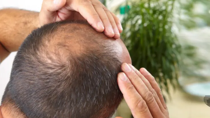 Hair loss treatment provides a chance for hair regrowth, leading to important gains in hair density.