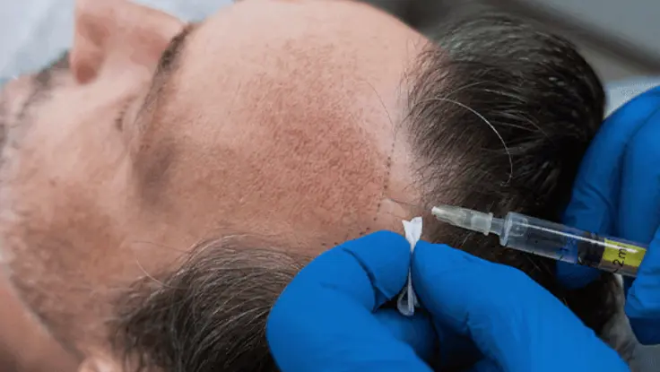 Top PRP Hair Transplant Treatment Clinic in Theni, Tamilnadu A man is seated, as a trichologist injects a man's head for platelet-rich plasma hair treatment.