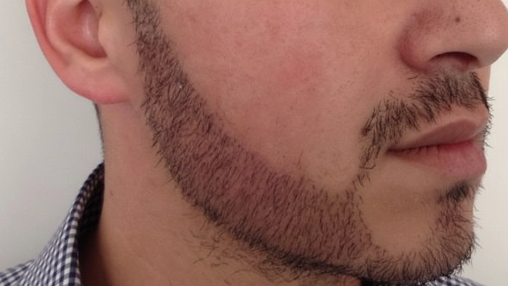 Advanced beard treatment and grooming solutions in Chennai clinic