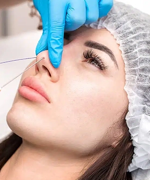 Bunny lines Botox treatment to reduce nose creases, smooth upper-face wrinkles, and improve expression lines