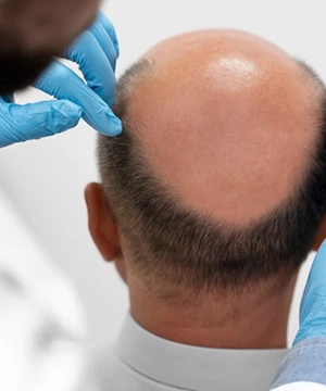 Sapphire transplant Chennai addresses crown bald spots, blending naturally for fuller scalp coverage