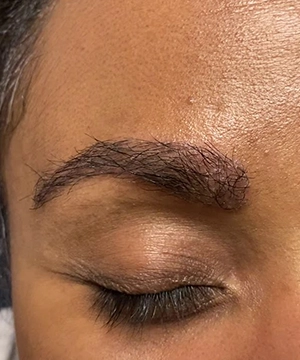 Sapphire eyebrow transplant Chennai restores thin or plucked brows with delicate, realistic grafts.
