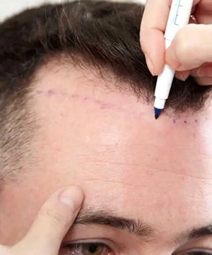 Sapphire hair transplant in Chennai strengthens frontal and mid areas, maintaining even hair density