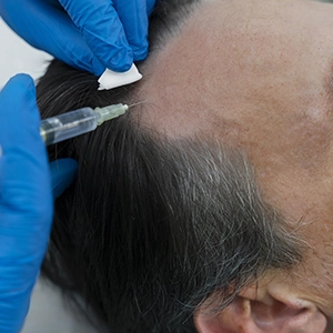 TriCell PRP hair therapy in Cumbum targets receding hairlines and boosts natural hair regrowth effectively.