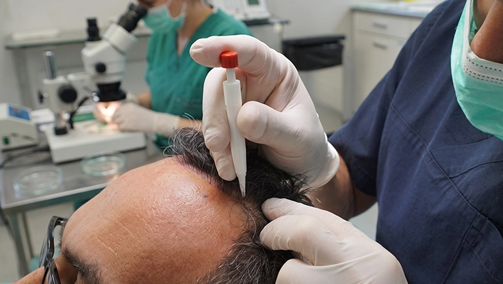 Specialist using Choi Pen for dhi method hair transplant in Hosur
