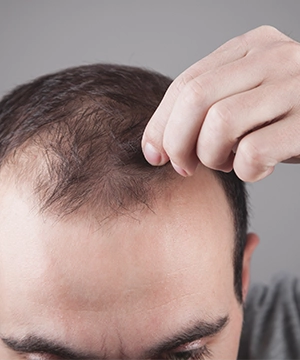 TriCell PRP hair therapy in Karur targets receding hairlines and boosts natural hair regrowth effectively.