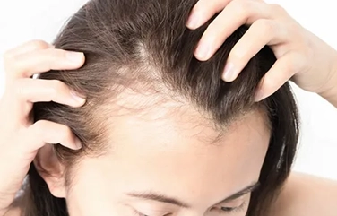 Best hair fall treatment in Sengunthapuram, Karur for effective hair regrowth and scalp health.