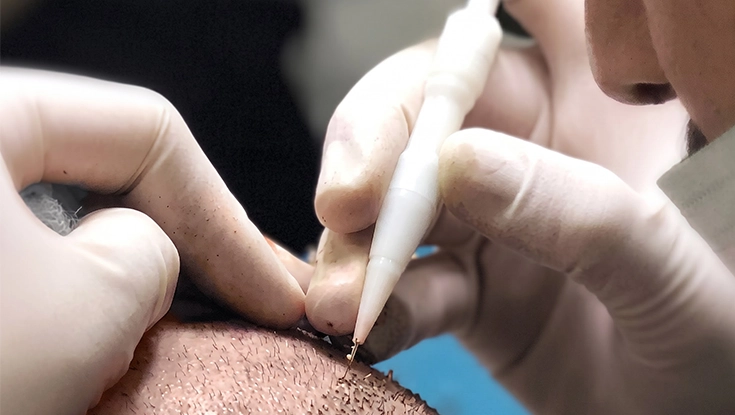 Specialist performing dhi method hair transplant procedure for hair loss in Pudukkottai