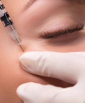 Crow’s feet Botox treatment to reduce fine lines near the eyes, keeping the area smooth and natural-looking