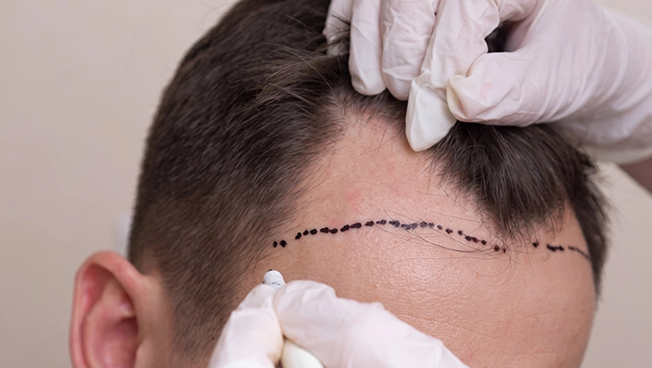 Specialist performing dhi method hair transplant procedure for hair loss in Salem