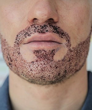 Restore receding hairlines naturally with SHI hair transplant solutions, boosting density  in Sivakasi.