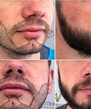 Define beard shape naturally with our Bio-FUE beard transplant offering lasting, in  results Sivakasi.