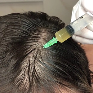 Tri-Cell PRP restores fuller hairline edges, helps with frontal thinning and side part receding.