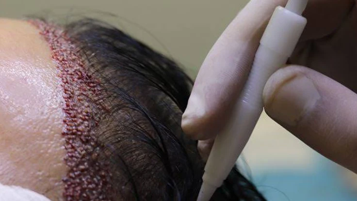 Specialist performing dhi method hair transplant procedure for hair loss in Tambaram