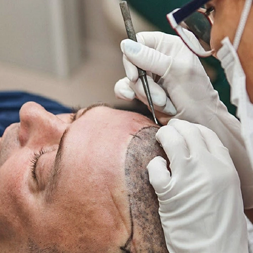 Achieve fuller, natural-looking hair with BIO FUE hair transplant by our experts in Tharamani.