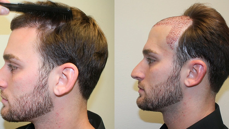 Restore natural hair volume with advanced Bio-FUE method ensuring fuller regrowth at Tharamani.