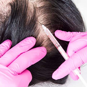 Targeted TriCell PRP treatment for mid-part line and diffuse hair thinning restoration in Tharamani.