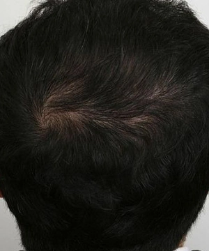 Reclaim fuller crown coverage with proven Bio-FUE hair restoration performed by experts, Tharamani.