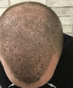 Revitalize thinning crown areas with hair restoration plans for fuller scalp coverage in Tharamani.