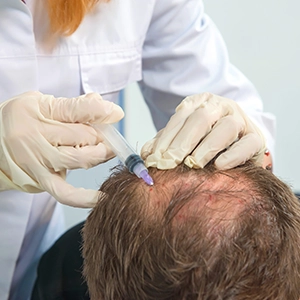 TriCell PRP therapy in Tharamani for reviving hair growth on the crown and top scalp with visible results.