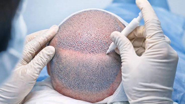 DHI method hair transplant treatment at Bonitaa Skin & Hair Care, Bharathi Nagar, Tharamani