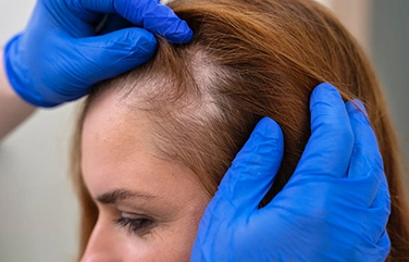 Expert dermatologists in Tharamani providing advanced hair loss treatments for natural regrowth and scalp health.
