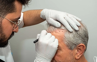 Hair transplant method in Tharamani for fuller natural hair regrowth and healthy scalp maintenance.