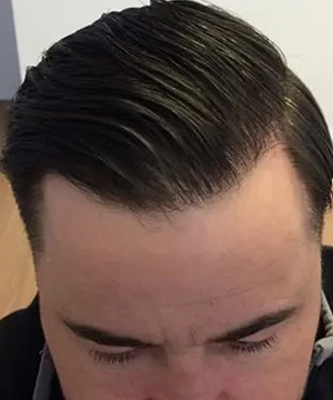 Achieve a defined hairline with our precision Bio-FUE transplant solutions now available, Tharamani.
