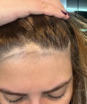 Achieve a natural-looking hairline with SHI transplant method that rebuilds frontal density  in Tharamani.