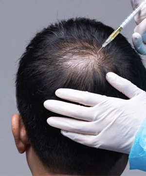 Rejuvenate scalp health with Y Cell PRP regenerative hair therapy for lasting results in Tharamani.