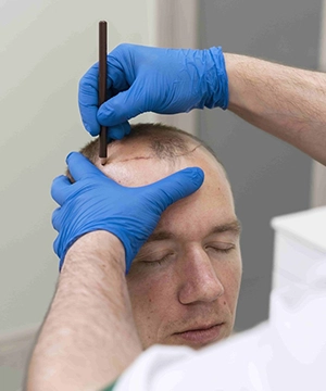 Get targeted mid-scalp SHI transplant services to restore density & balance for healthy hair in Tharamani.