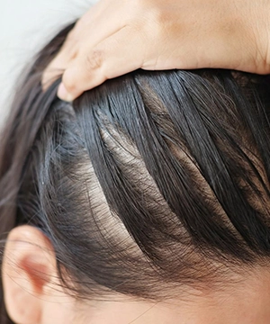 Get visible mid-scalp density with our precise Bio-FUE transplant method trusted by clients, Tharamani.