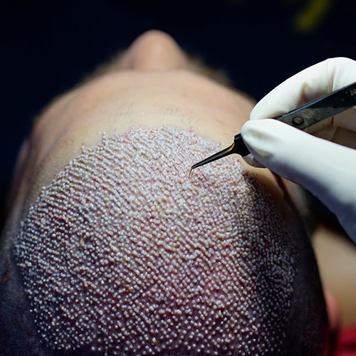 Restore hair  with Sapphire hair transplant solution for precise, long-lasting results in  Tharamani.