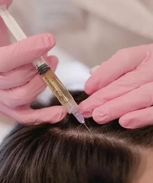 Revitalize your scalp & hair follicles with specialized scalp PRP treatments for fuller hair in Tharamani.