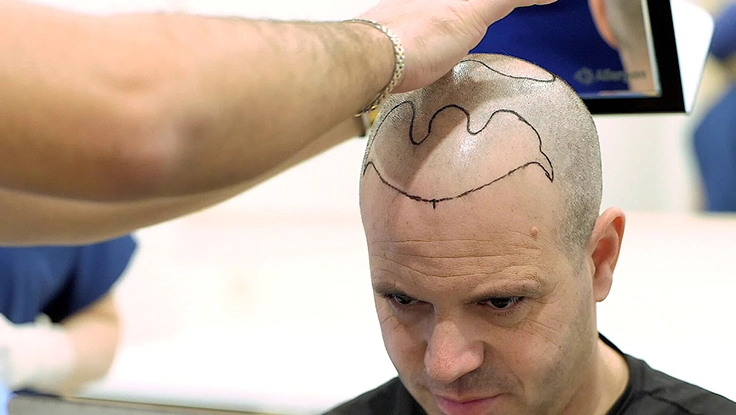 Restore receding hairlines naturally with SHI hair transplant solutions, boosting density  in Tharamani.