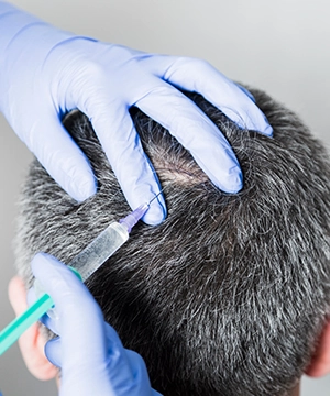 TriCell PRP boosts crown fullness, restores density for men’s and women’s bald spots.