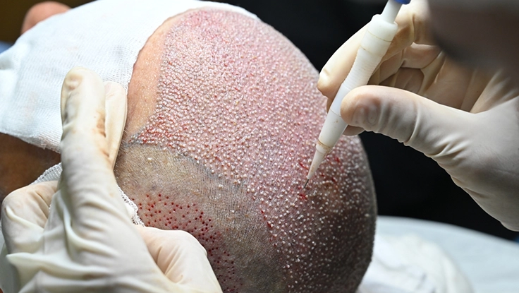 Specialist performing dhi method hair transplant procedure for hair loss in Thudiyalur