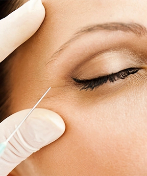 Crow’s feet Botox treatment to reduce fine lines near the eyes, keeping the area smooth and natural-looking